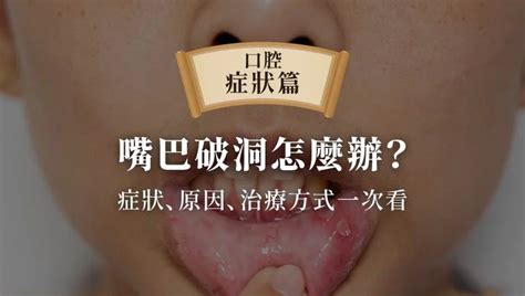 上嘴唇破|嘴巴破洞怎麼辦？症狀、原因、治療方式一次看